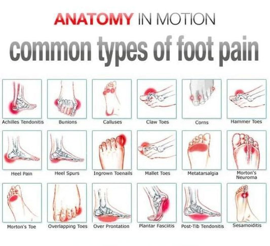 Hallux valgus – Wenn der große Zeh aus der Reihe tanzt