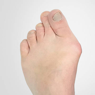 Hallux Valgus
